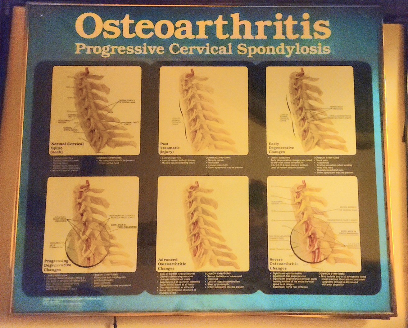 25×21 Framed Osteoarthritis picture